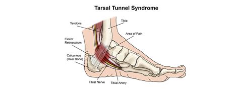 Tarsal Tunnel Syndrome: Symptoms, Causes, and Treatments | Dr. Geller