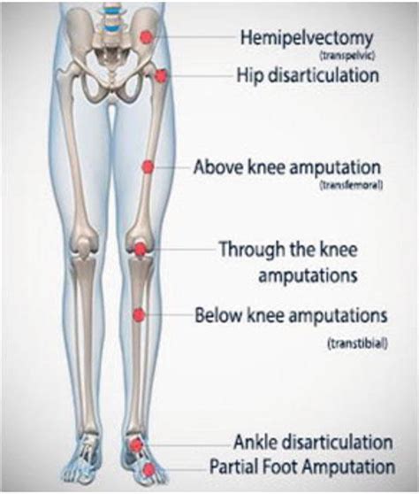 Prosthetics for Lower Limb Amputation | IntechOpen