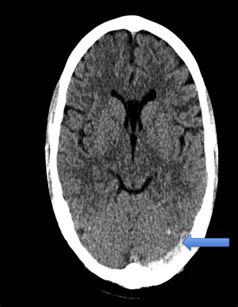 Cerebral Venous Sinus Thrombosis: The Forgotten Headache — NUEM Blog