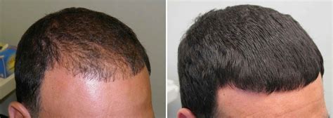 Finasteride Before and After Photos [2023]