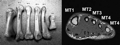 What causes metatarsal stress fracture in runners, and how can you ...