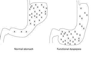 Functional Dyspepsia Diagnosis and Treatment ~ Digestive Diseases