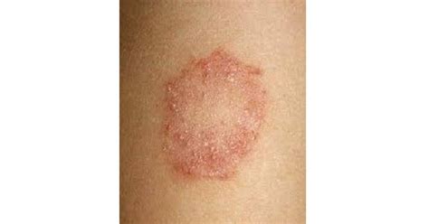 Dermatophytes - www.medicoapps.org