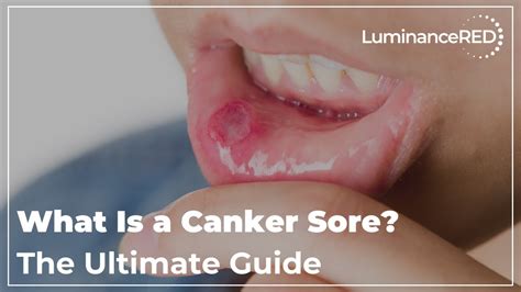 What Is a Canker Sore? The Ultimate Guide - YouTube