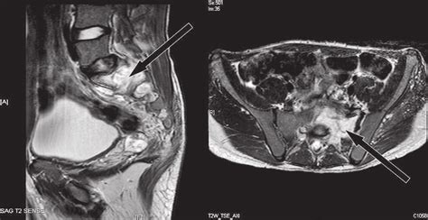 Preoperative MRI. There is a large mass lesion, hypointense in T1 and... | Download Scientific ...