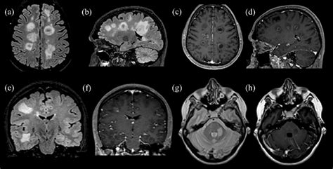 Representative examples of MS patients presented with tumefactive ...