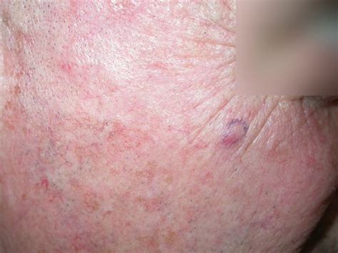 ACD A-Z of Skin - Merkel cell carcinoma