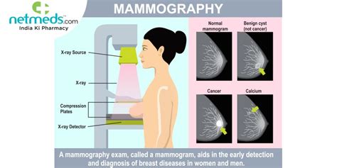 Diagnostic Mammogram Procedure