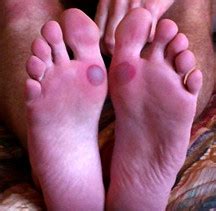 Blood Blisters | Blood blisters under the the big toe joints… | Northcoast Footcare | Flickr