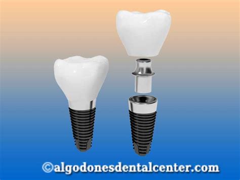 Dental Implants in Algodones near Yuma, AZ | Algodones Dental Center