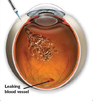 Intravitreal Injection | Rand Eye Institute