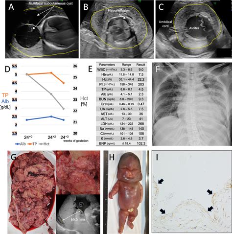 Figure 1 from A case of non-immune hydrops fetalis with maternal mirror ...