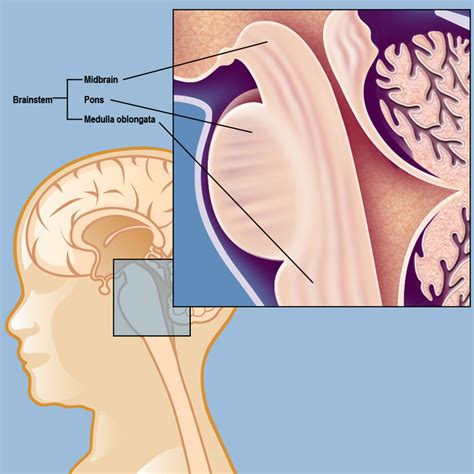 Brainstem Gliomas | Weill Cornell Brain and Spine Center