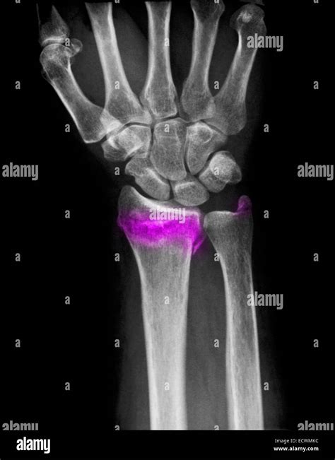 Wrist x-ray showing a fractured distal radius and ulna Stock Photo - Alamy