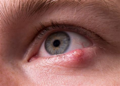 Is it a Chalazion or Stye? - Eye Surgeons Associates PC