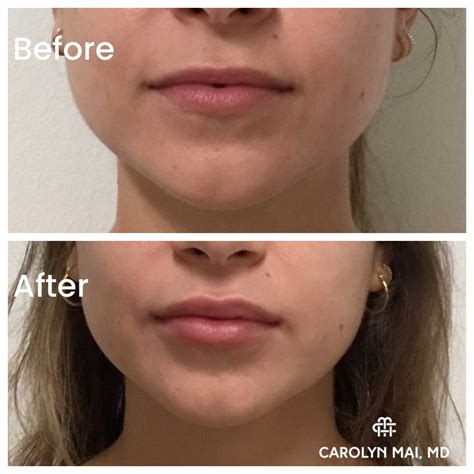 The Best Treatments For Lip Lines – Botox vs. Fillers - Dr. Carolyn Mai Honolulu Botox & Filler ...