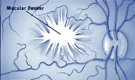 Macular Pucker | Retina Specialists | Eye Surgery | Retina Associates ...