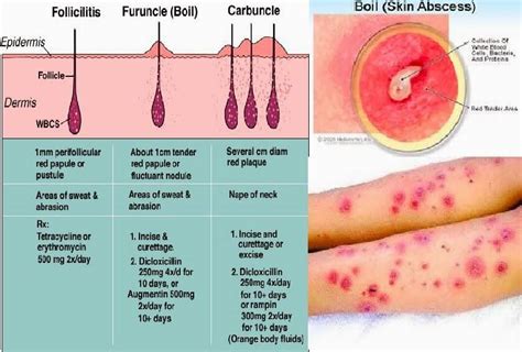 TREATMENT FOR BOILS - by Dr. Tsan at Philadelphia Homeopathic Clinic