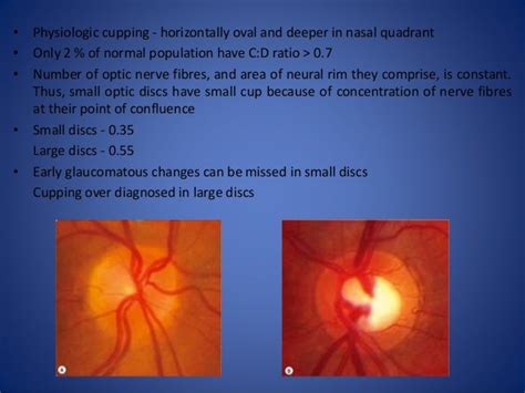 Optic disc evaluation