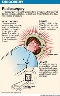 Gamma Knife Surgery Radiosurgery Illustration - OHC - Oncology ...