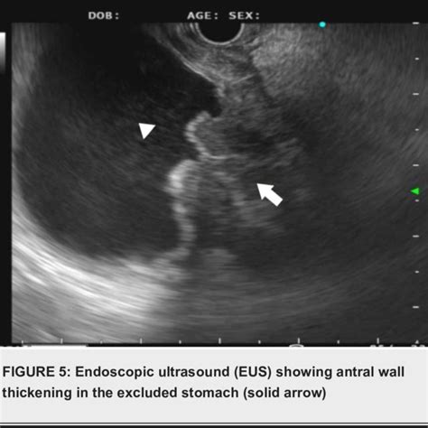 Endoscopic view of infiltrative ulcerated mass in prepyloric region and ...