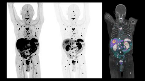 Single-bed, whole-body 68Ga DOTATATE PET/CT delineation of ...