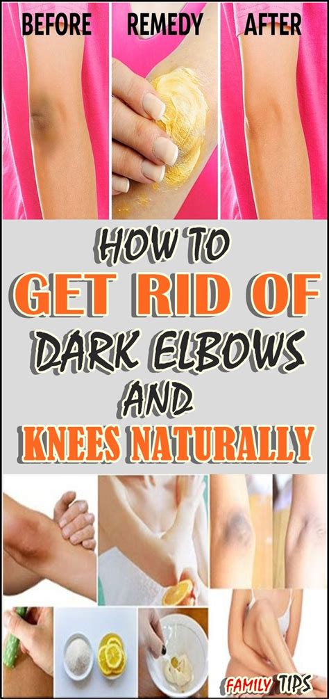 HOW TO GET RID OF DARK ELBOWS AND KNEES NATURALLY | Dark elbows, Remedies, Natural headache remedies