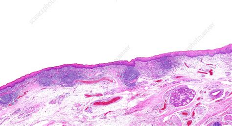 Inflammatory nodules on larynx, light micrograph - Stock Image - C058/0683 - Science Photo Library