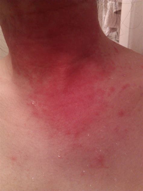 allergic reaction to bactrim - pictures, photos