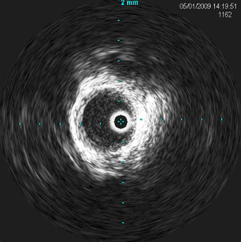 Cureus | Intravascular Ultrasound for Intracranial and Extracranial ...