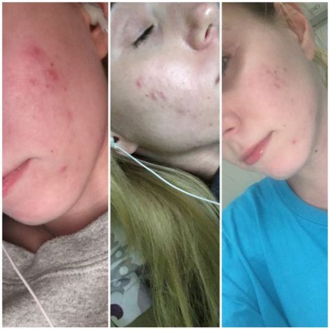 Finally seeing results! 100 mg Minocycline daily since December : r/acne