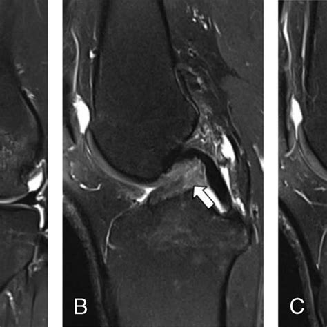 MRI of the left knee of a 38-year-old woman with knee injury 3 months... | Download Scientific ...