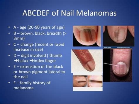 Big Toenail Has Vertical Light Brown Line: Melanoma? — Scary Symptoms