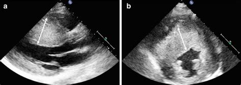 Basic Echocardiography in Hypertrophic Cardiomyopathy | Radiology Key