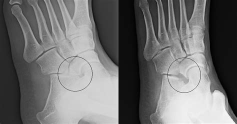 Tarsal Coalition: Tarsal Resection Before and After X rays