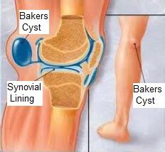 Knee Bursitis: Symptoms, Diagnosis & Treatment - Knee Pain Explained