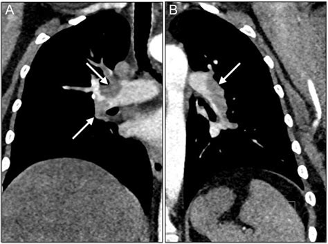 Pulmonary Embolism - Causes, Signs & Symptoms, Diagnosis, Treatment