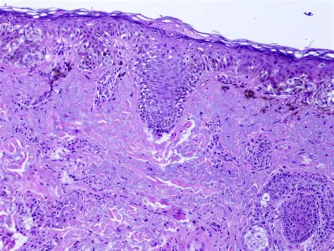 Pathology Outlines - Lentigo maligna melanoma