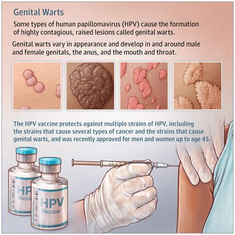 Genital Warts | Dermatology | JAMA | JAMA Network