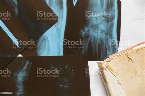 Xrays Of A Womans Hand With A Fracture Xray Health Care Stock Photo ...