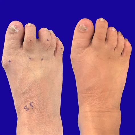 Before and After Bunion Surgery Photos | The Bunion Cure