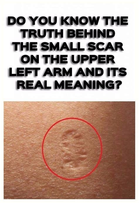 Do You Know The Truth Behind The Small Scar On The Upper Left Arm And ...