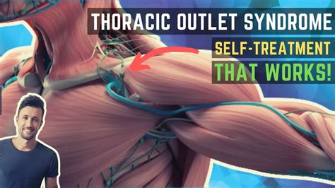 Thoracic Outlet Syndrome Treatment That Actually Works! - YouTube