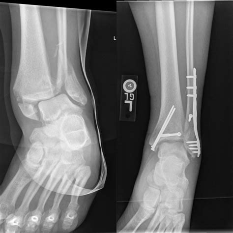 ANKLE FRACTURE BEFORE AND AFTER | Buyxraysonline