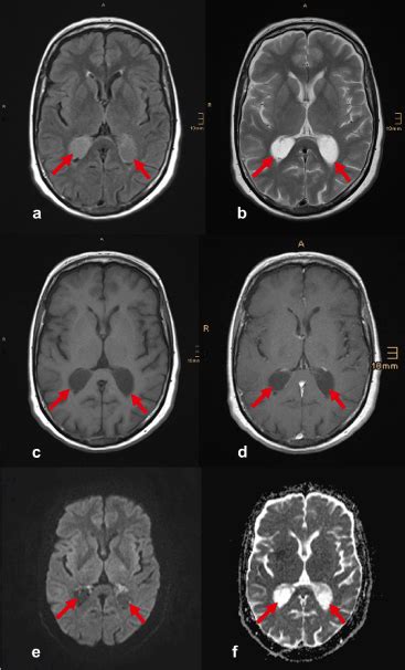 Bilateral choroid plexus cysts (xanthogranulomas)