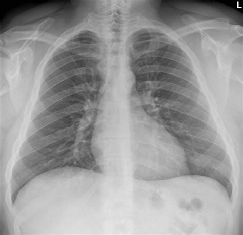 Sternoclavicular Joint Dislocation • LITFL • Trauma library