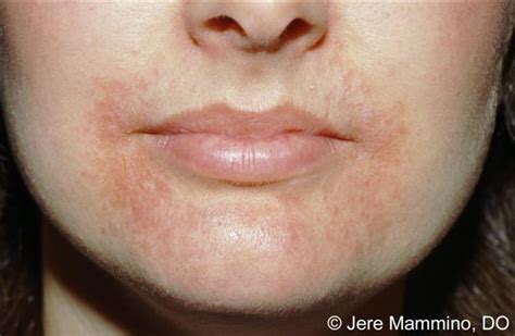 Perioral Dermatitis - American Osteopathic College of Dermatology (AOCD)