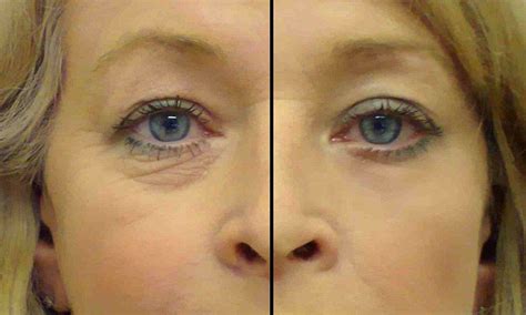 Banish the bags in just 15 minutes: Miracle anti-wrinkle eye patch can ...