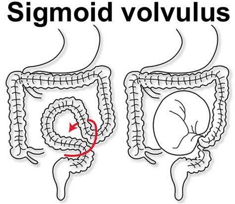 Sigmoid colon anatomy, location, function, polyps, diverticulosis & cancer