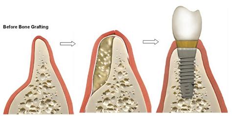 Bone & Soft Tissue Grafting for Dental Implants | Bone & Soft Tissue Grafting for Dental ...